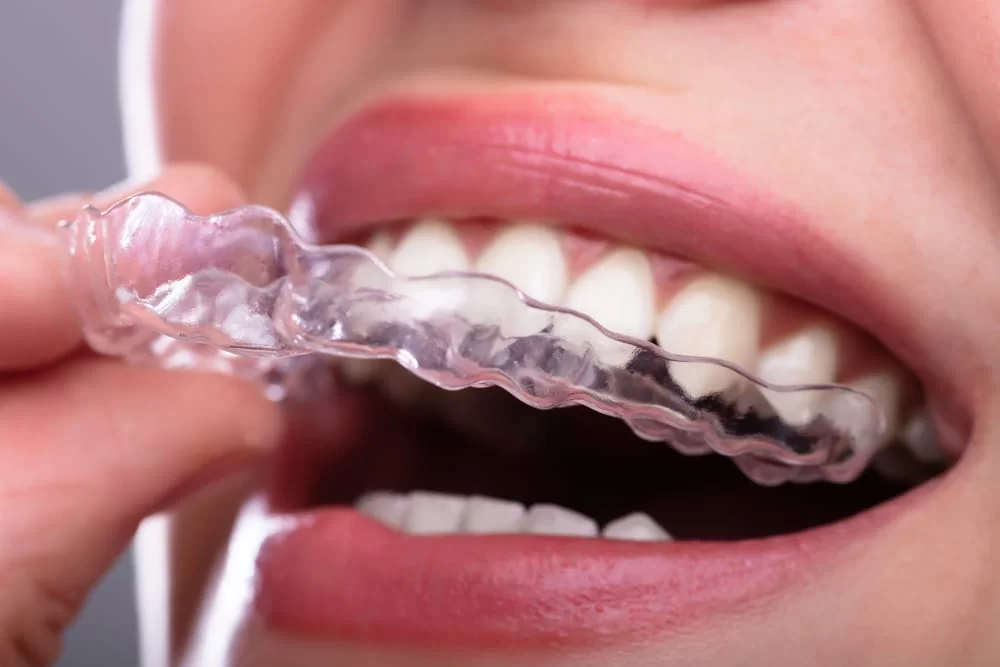 Invisible aligners