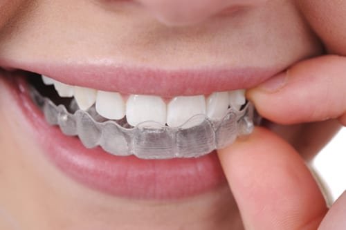 Invisible Aligners and Orthodontics