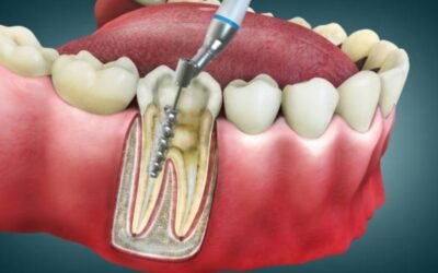 Dental Implants – A Permanent Solution for Missing Teeth