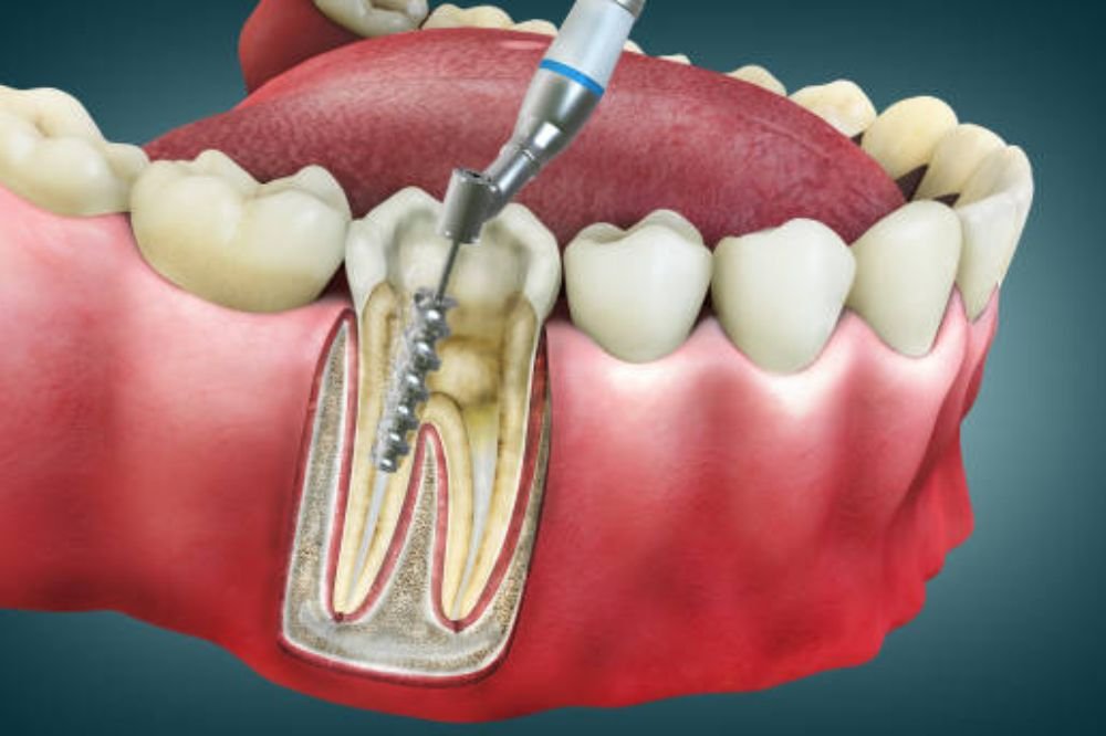 Root canal treatment2 Root canal treatment