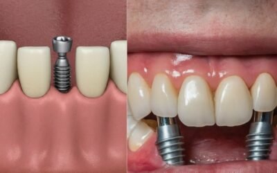 Dental Implants – A Permanent Solution for Missing Teeth