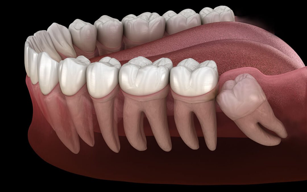 Wisdom Tooth Removal – Safe and Painless Treatment in Palava