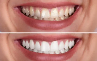 Teeth Cleaning and Bleaching for a Bright Smile