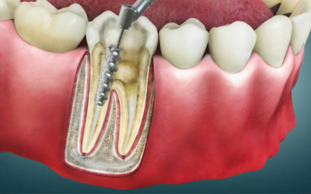 Root Canal Treatment: A Complete Guide to Saving Your Tooth