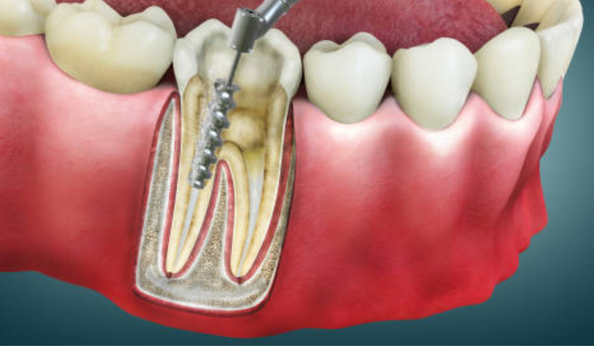 Root Canal Treatment