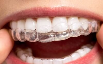Clear Aligners for a Healthy and Confident Smile