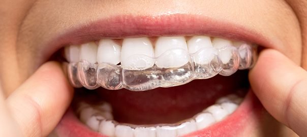 Aligners for a Healthy and Confident Smile